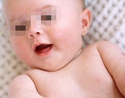 武汉儿童白癜风的症状有什么 武汉白癜风早期症状有哪些