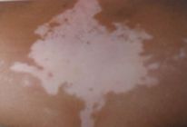 武汉白癜风的患者可以用中药治疗吗 武汉早期白癜风怎样治疗比较好